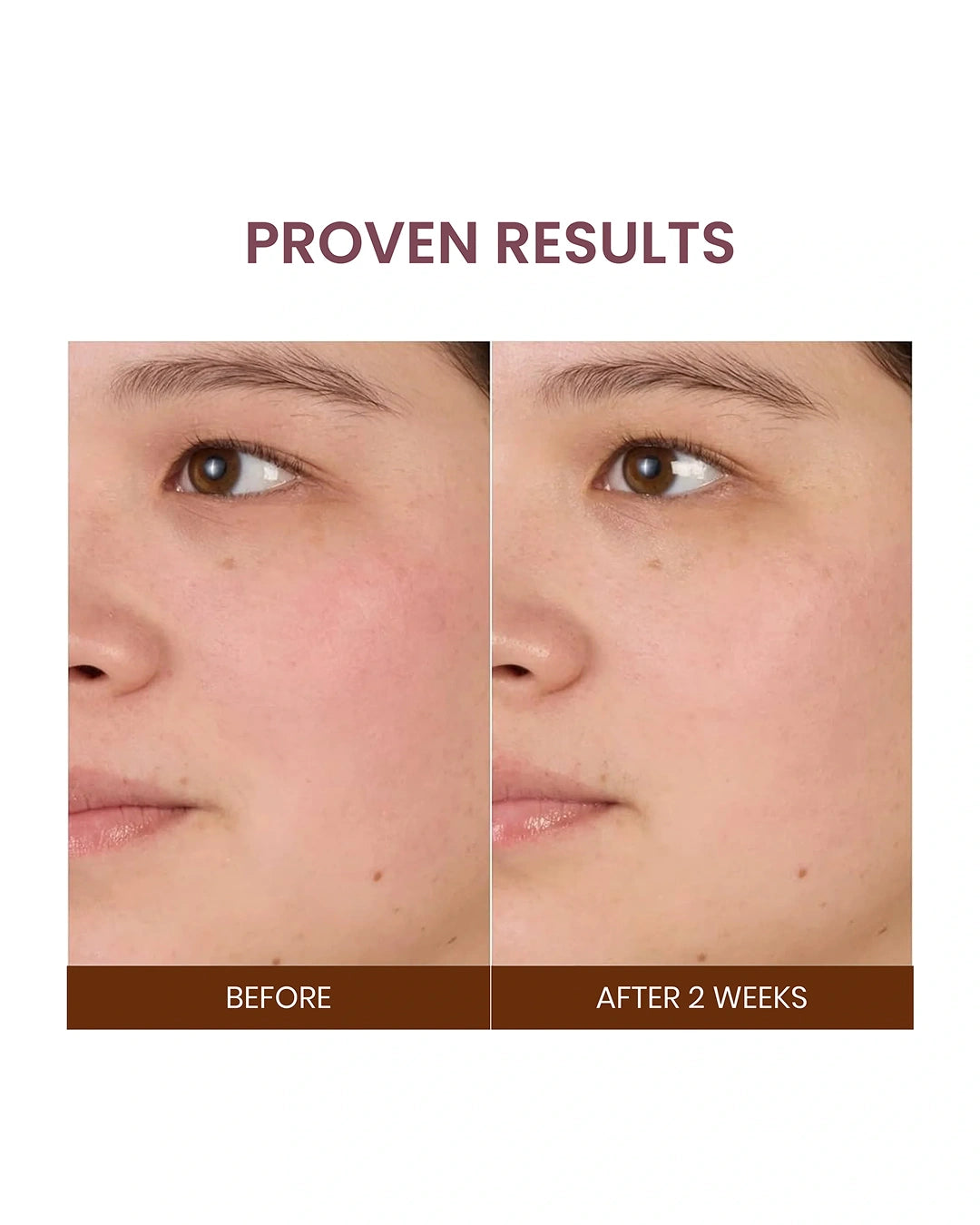 Before-and-after skin comparison showing a woman's cheek and nose area, with the text 'PROVEN RESULTS' above and 'BEFORE' and 'AFTER 2 WEEKS' below.