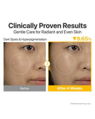 Before-and-after skin comparison graphic showing a woman's cheek with visible blemishes in the 'Before' panel and clearer skin in the 'After 4 Weeks' panel, with text reading 'Clinically Proven Results' and 'Dark Spots & Hyperpigmentation'.