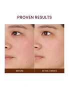 Before-and-after skin comparison showing a woman's cheek and nose area, with the text 'PROVEN RESULTS' above and 'BEFORE' and 'AFTER 2 WEEKS' below.