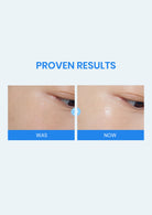 Before and after comparison of eye area treatment with 'Proven Results' text on a blue background.