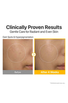 Before and after comparison of skin treatment for dark spots and hyperpigmentation with text 'Clinically Proven Results'.