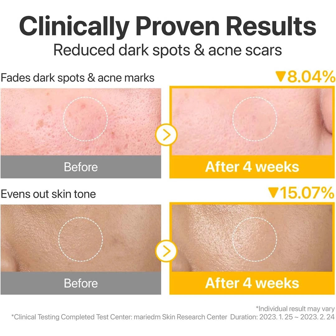 Before and after skin treatment results showing reduced dark spots and acne scars with clinical data.